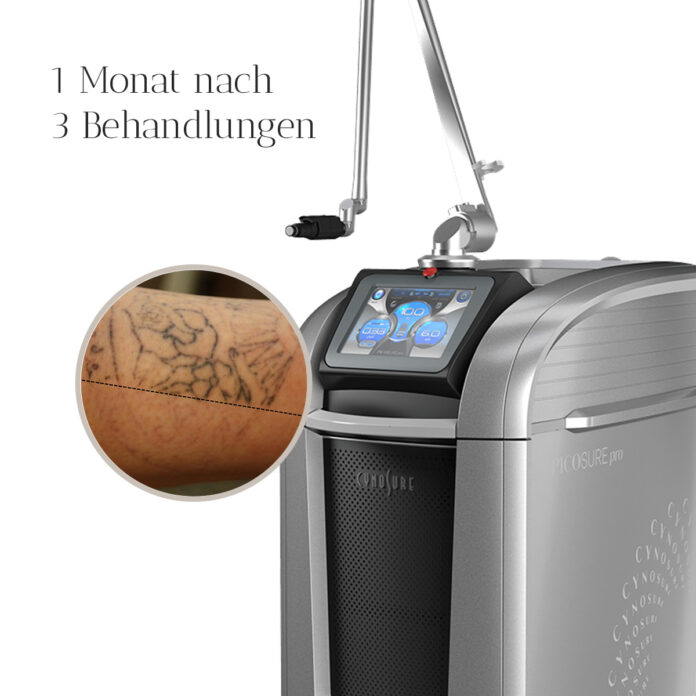 Risiken und Kosten einer PicoSure® Pro Behandlung