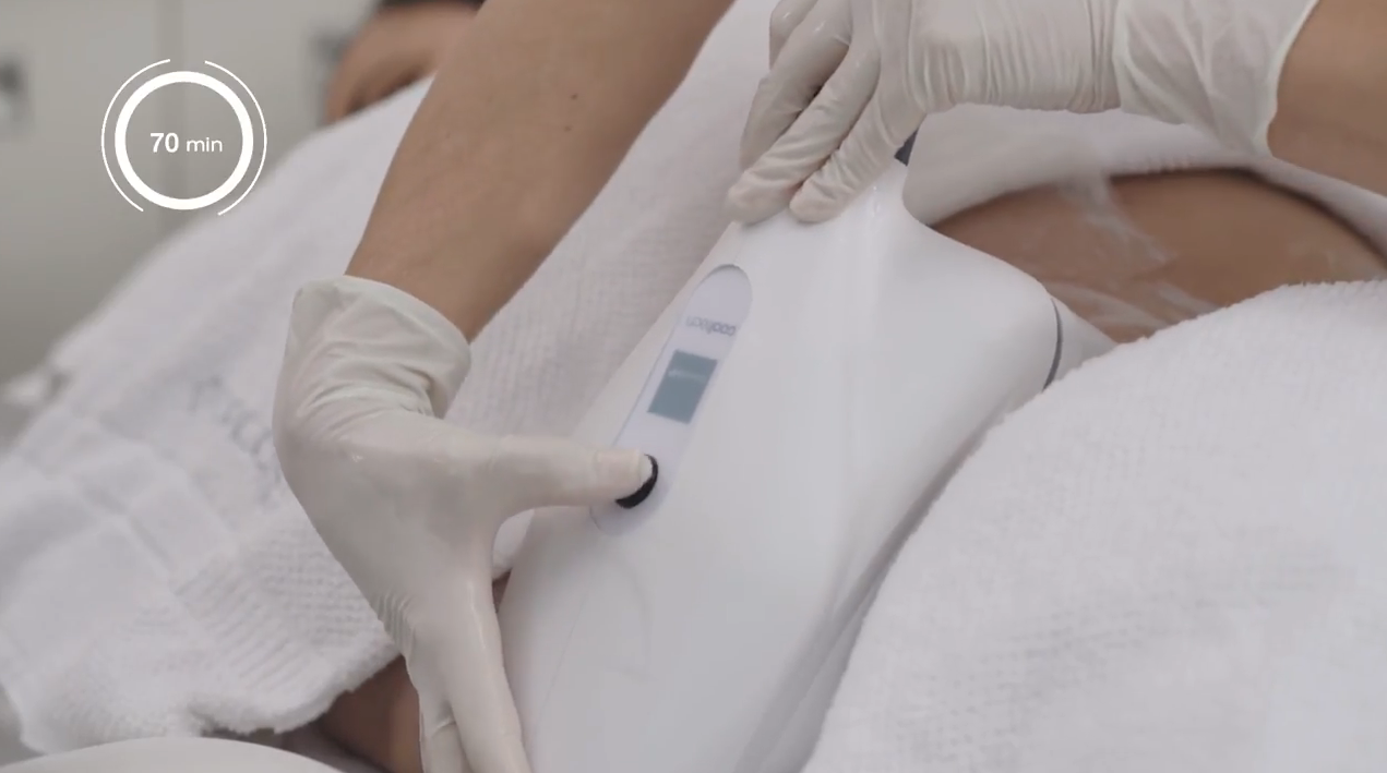 Video zur CoolTech Behandlung