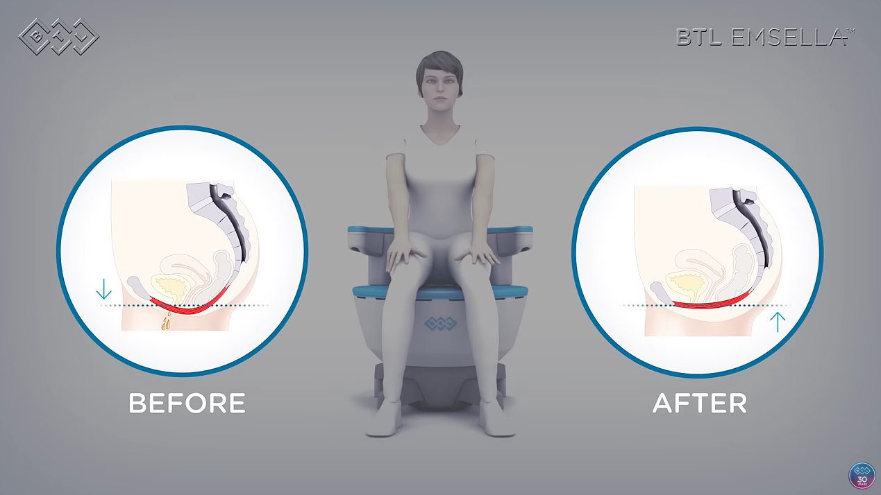Video zur Emsella Behandlung