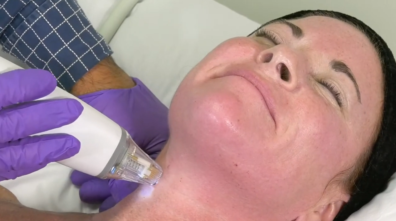 Video zur Potenza® RF Microneedling Behandlung