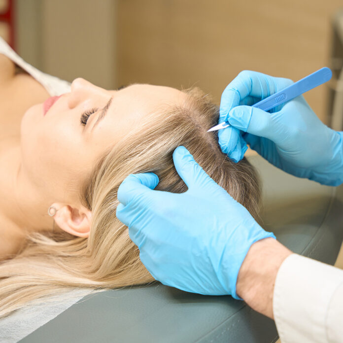 Biofibre® Haartransplantation