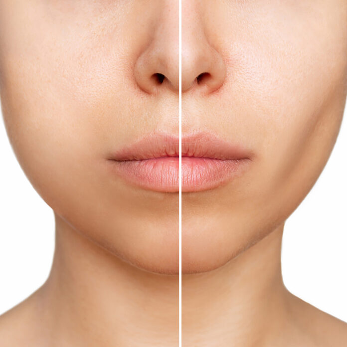 Buccal Fat Removal Informationen auf einen Blick