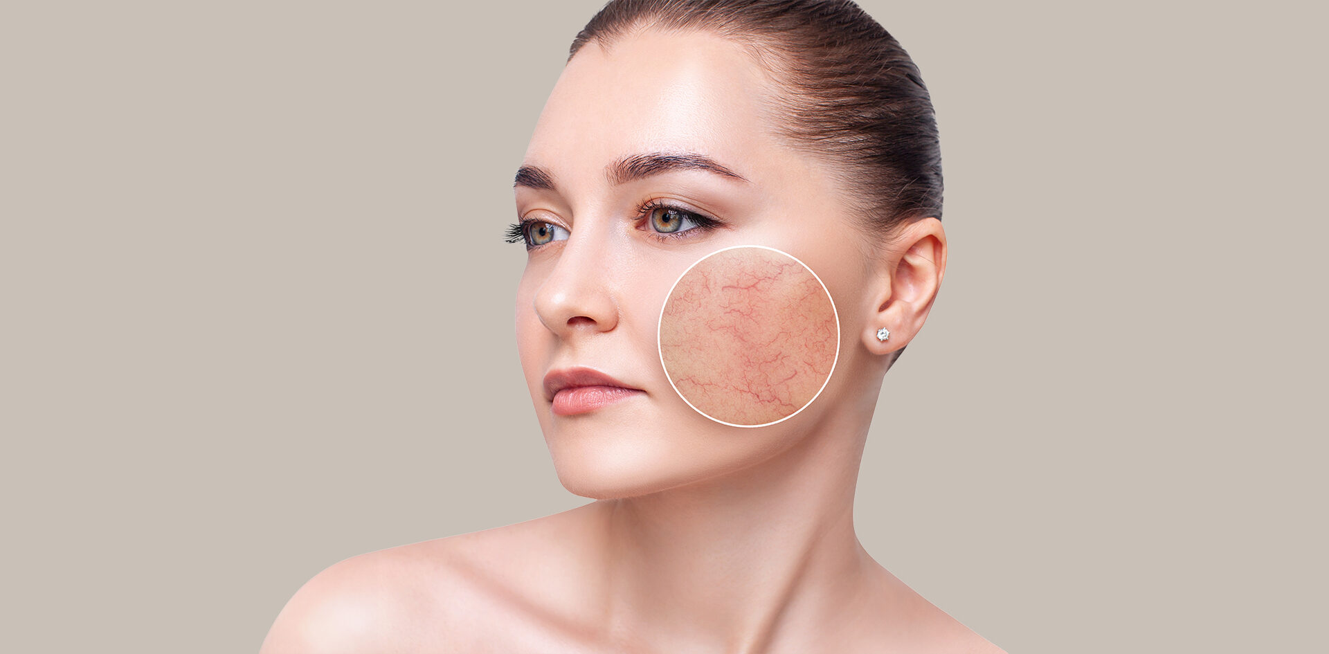 Couperose Behandlung in Berlin