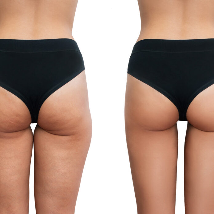 Gründe einer Vaser Smooth Behandlung