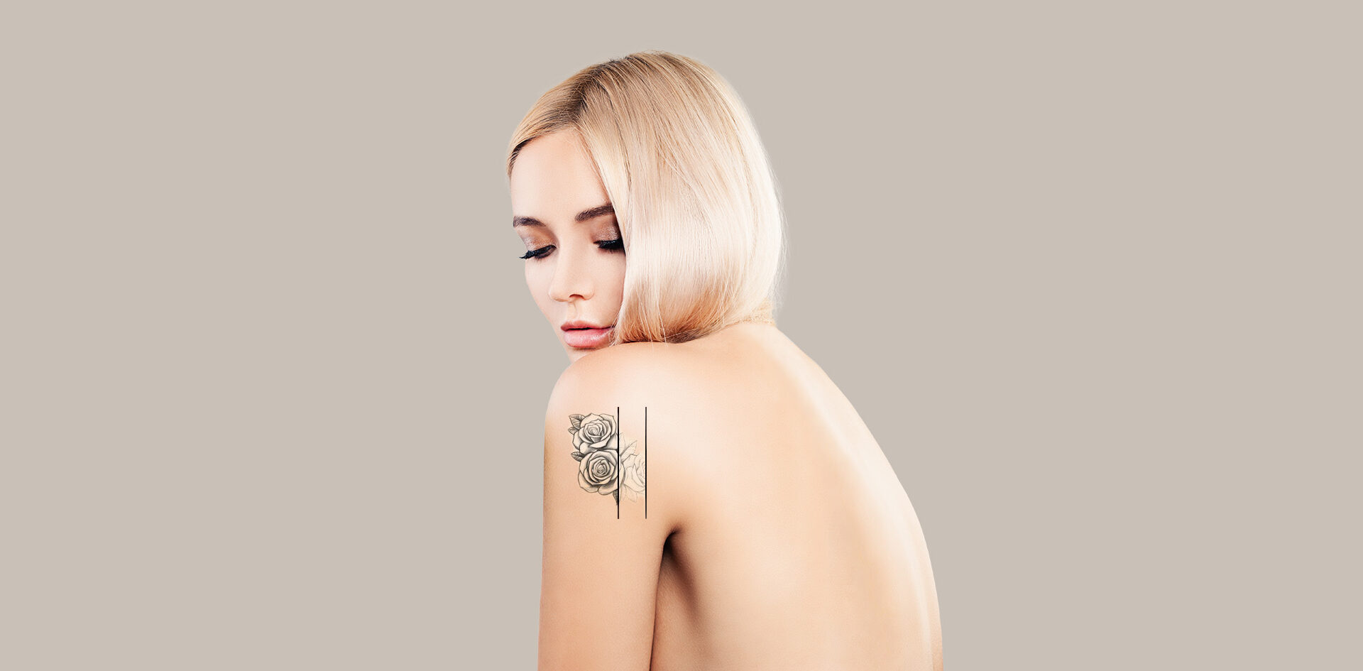 Tattooentfernung mit PicoSure