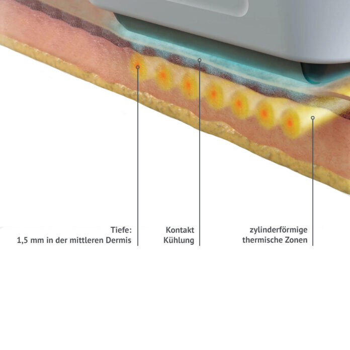 Was ist eine Sofwave Behandlung