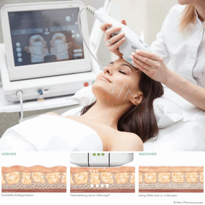 Definition Ultherapy Prime