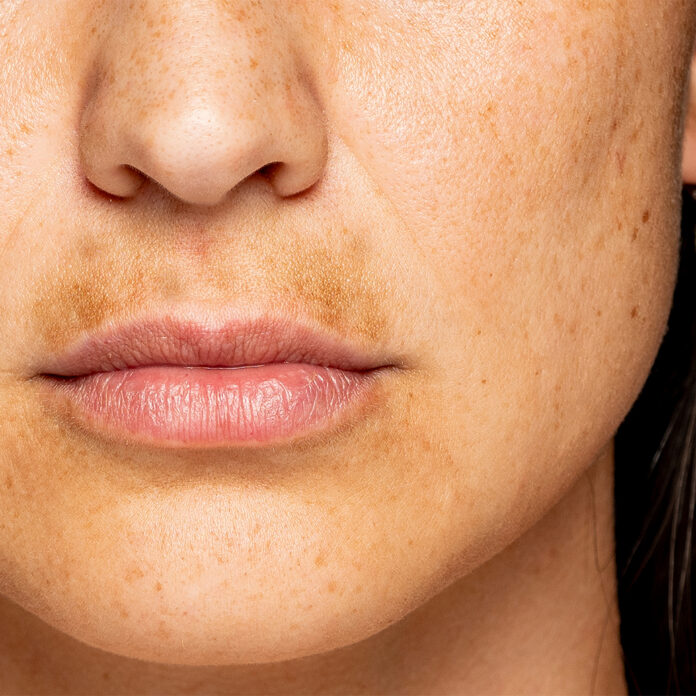 Pigmentflecken Gesicht