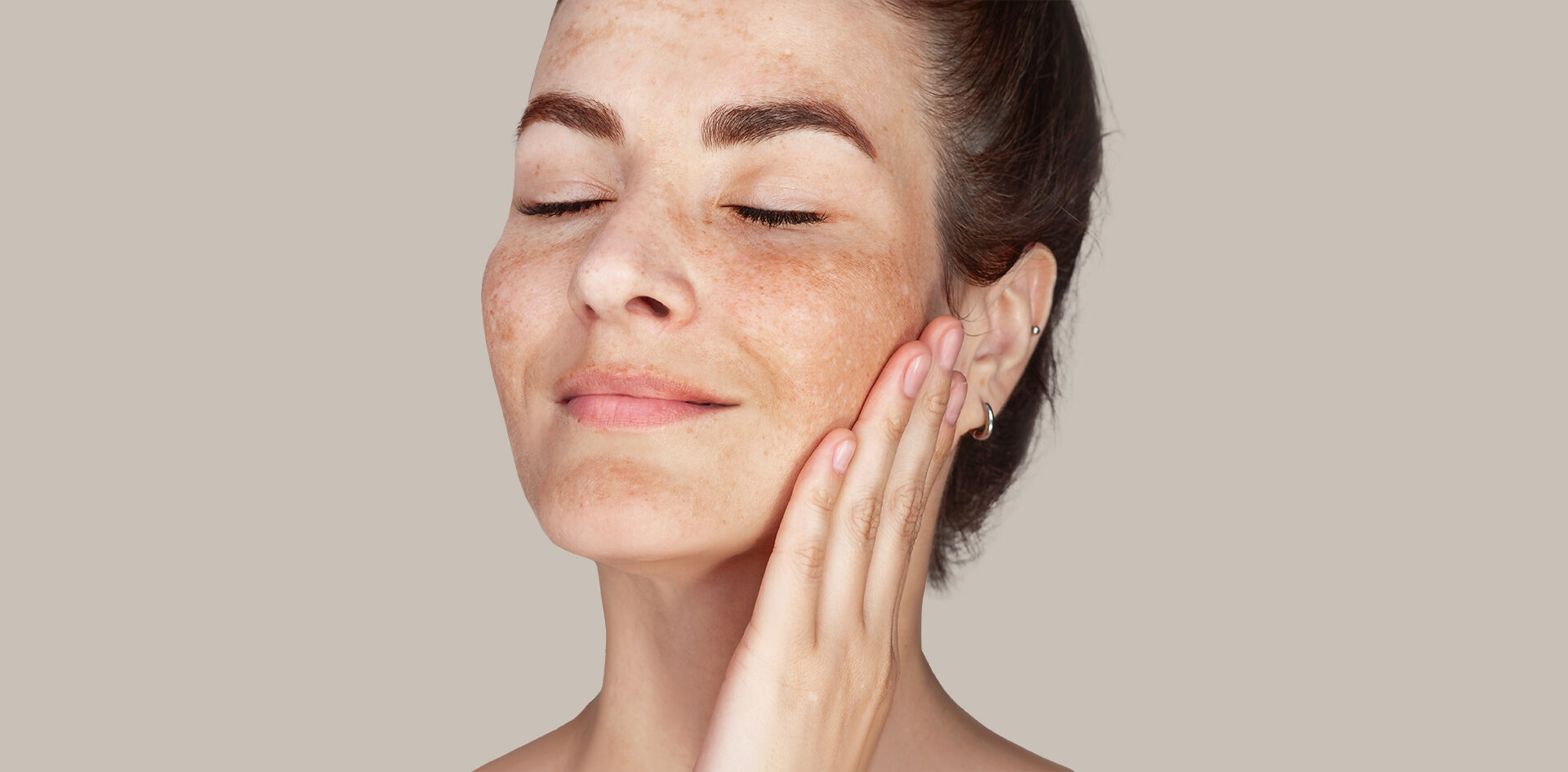 Pigmentflecken Behandlung in Berlin