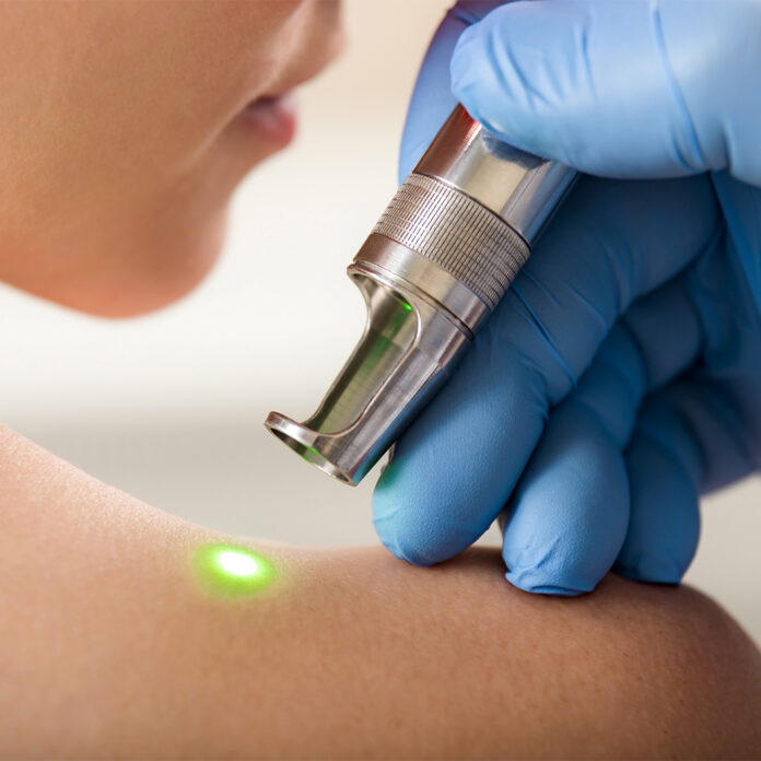 Pigmentstörungen behandeln