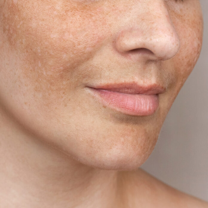 Ursachen von Pigmentstörungen