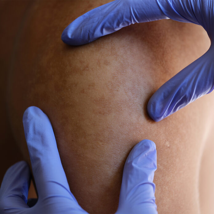 Wann darf eine Pigmentbehandlung nicht durchgeführt werden