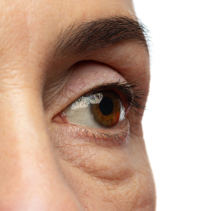 Was versteht man unter Augenringen