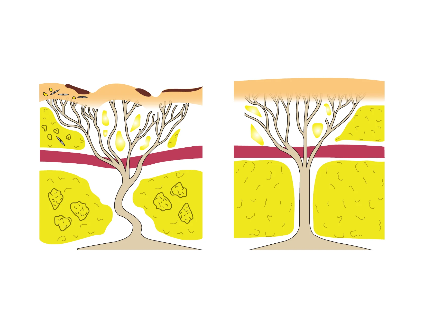 Schematische Darstellung der Gewebestruktur zur Wirkweise von XERF