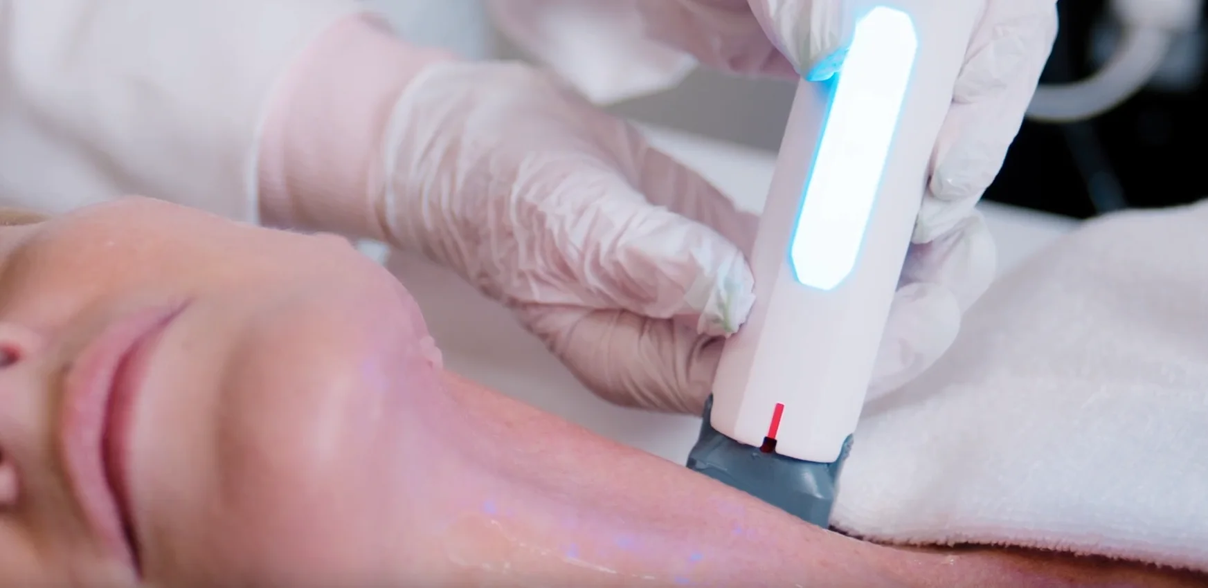 XERF Radiofrequenzbehandlung am Hals