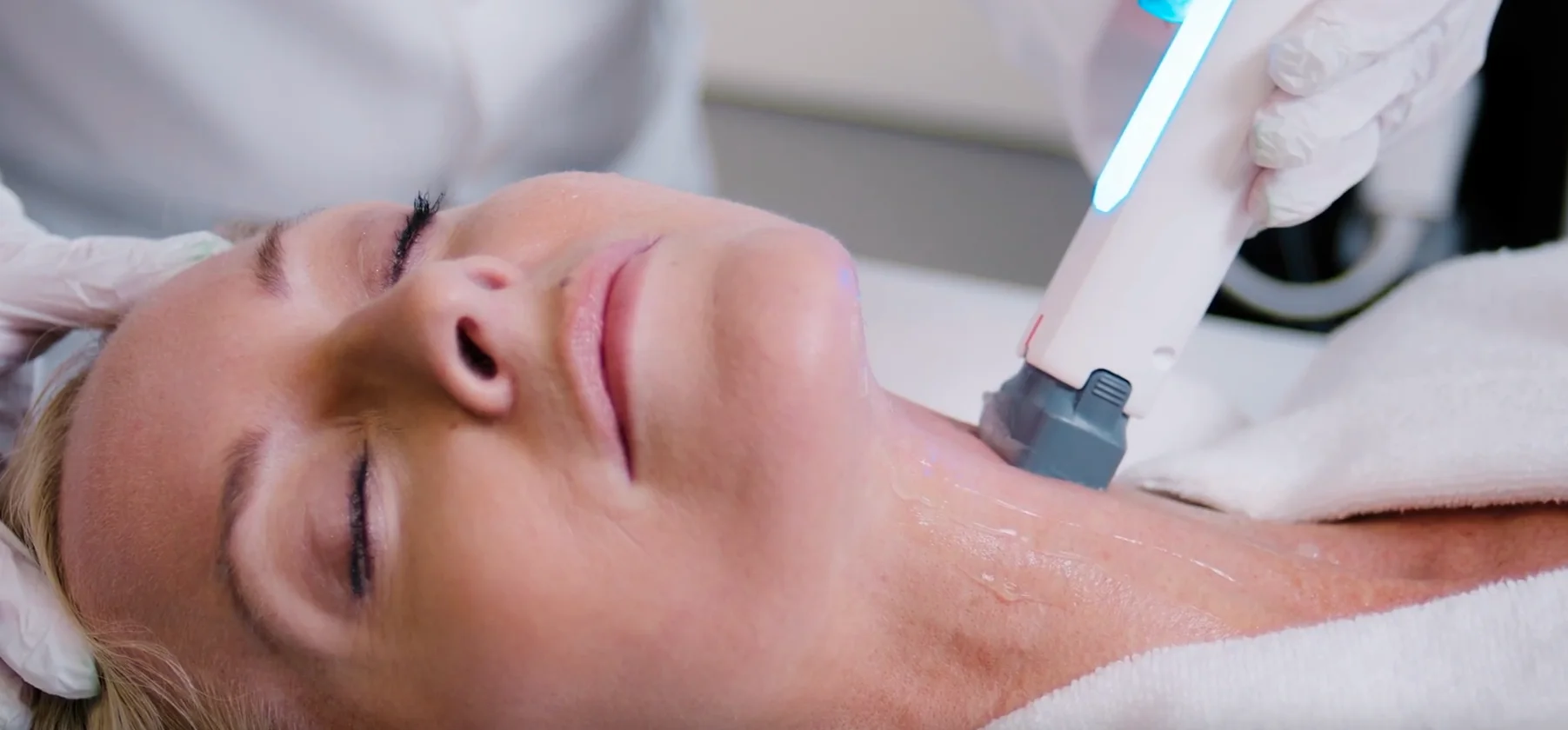 XERF Radiofrequenzbehandlung an Hals und Dekolleté